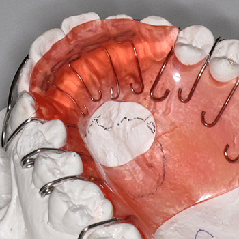 orthodontic retention