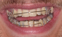 invisalign